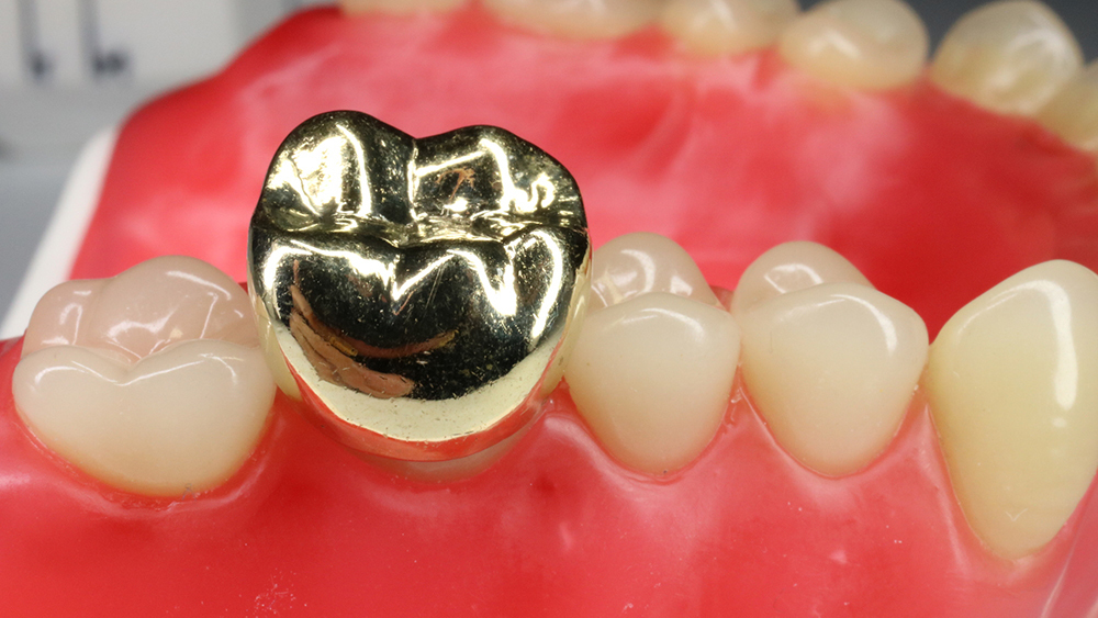 千葉市若葉区の審美歯科（白い詰め物・被せ物）