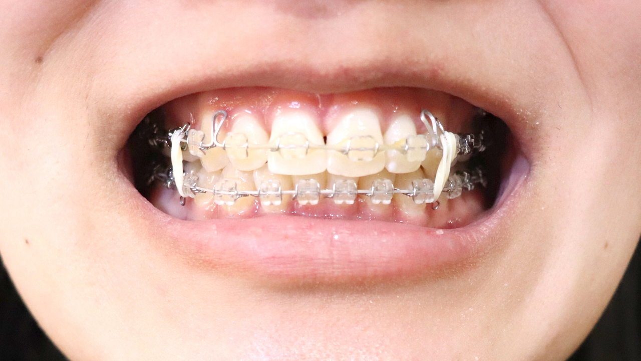 千葉市若葉区の小児矯正