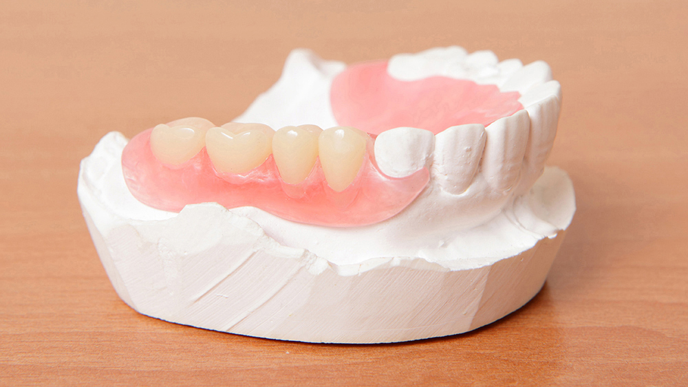 千葉市若葉区の入れ歯の治療