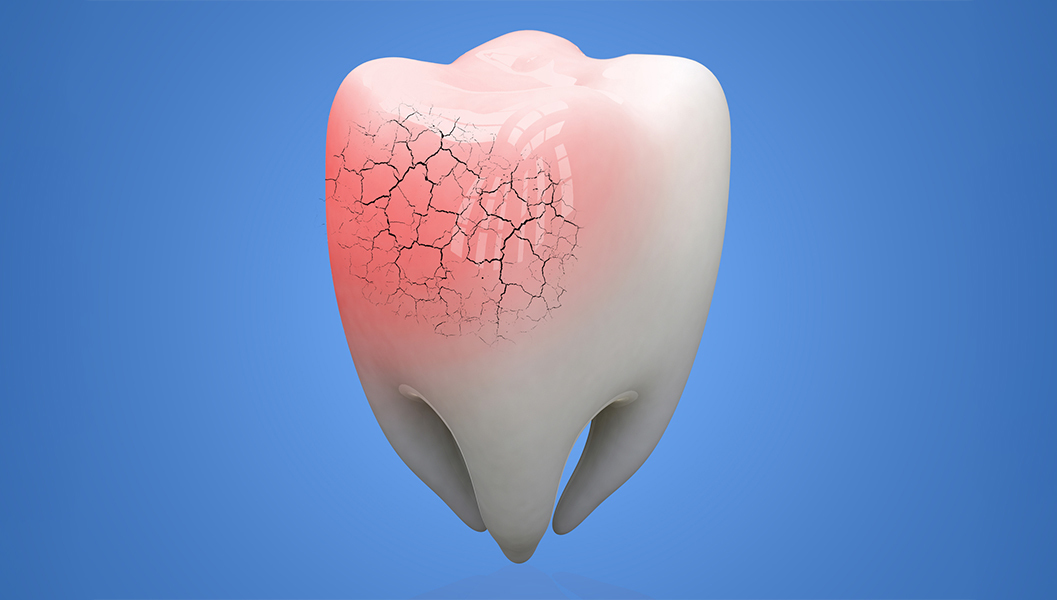 千葉市若葉区のダイレクトボンディング