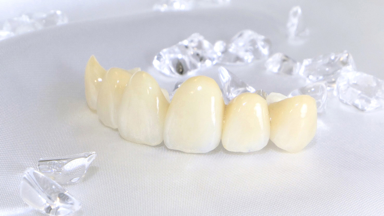 千葉市若葉区の審美歯科（白い詰め物・被せ物）