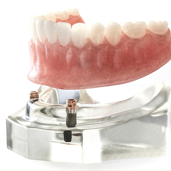 千葉市若葉区の入れ歯の治療