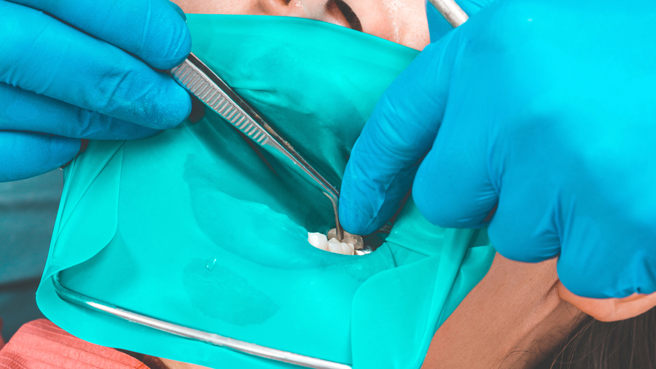 千葉市若葉区の精密根管治療