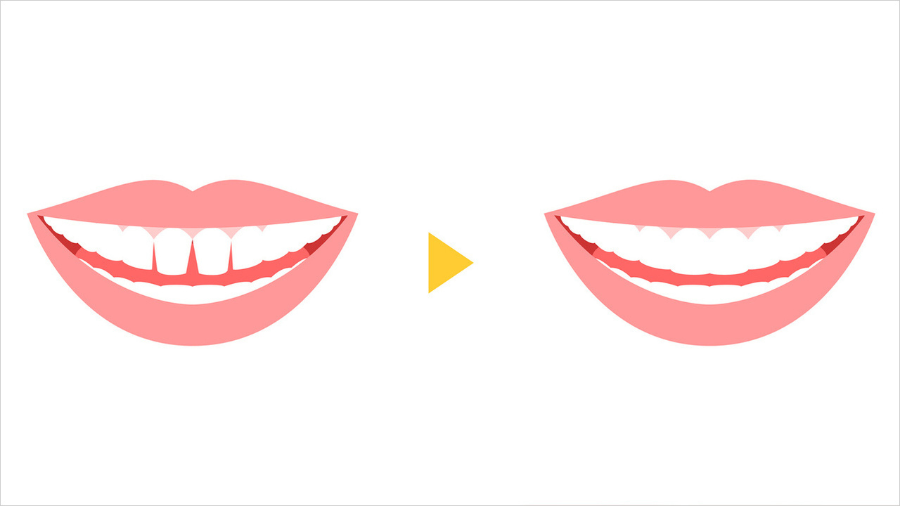 千葉市若葉区のダイレクトボンディング