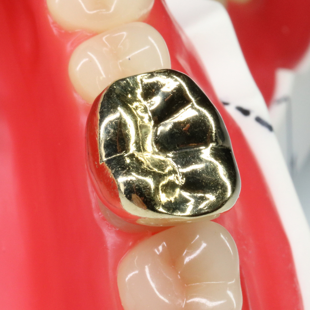 千葉市若葉区の審美歯科（白い詰め物・被せ物）