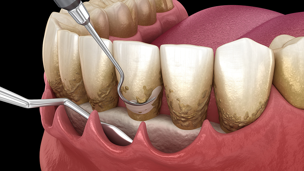 千葉市若葉区の歯周病治療