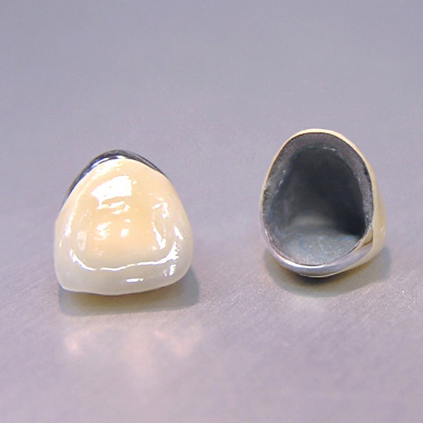 千葉市若葉区の審美歯科（白い詰め物・被せ物）