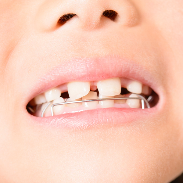 千葉市若葉区の小児矯正