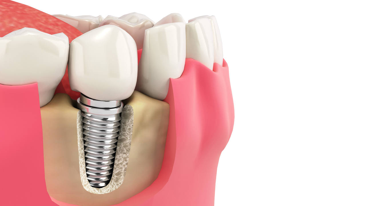 千葉市若葉区のインプラント治療