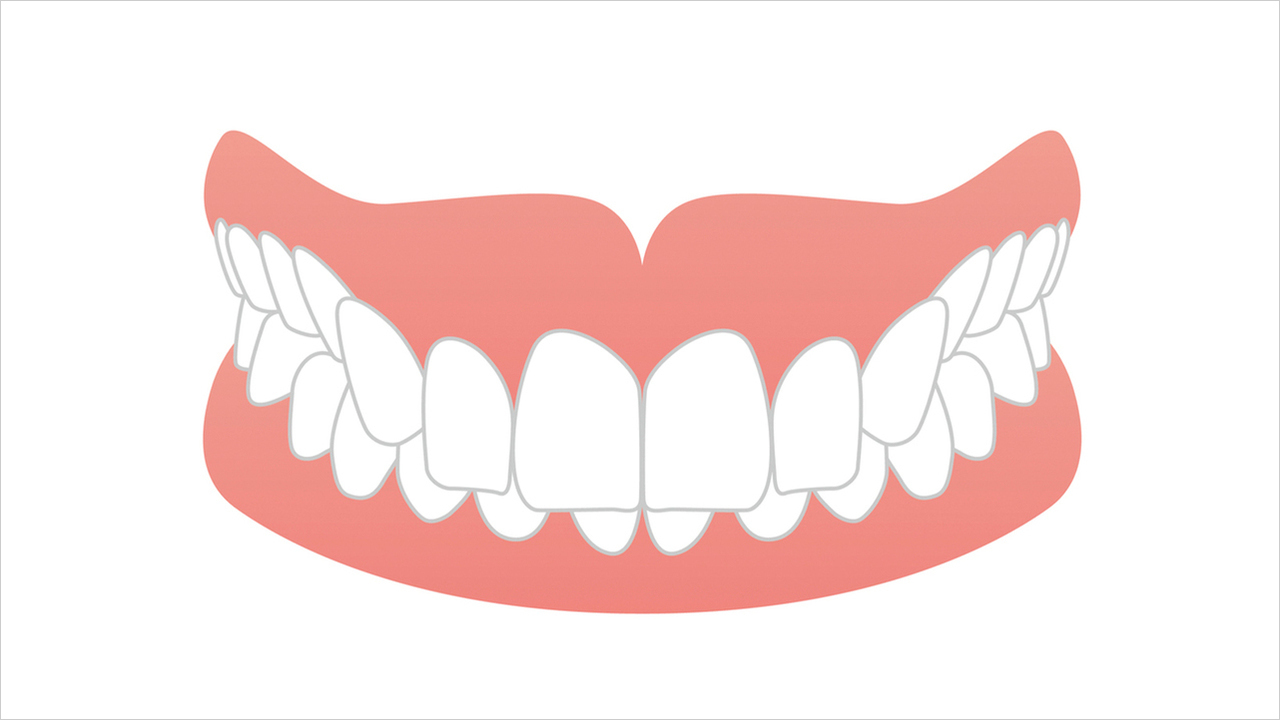 千葉市若葉区のボトックス治療（食いしばり）