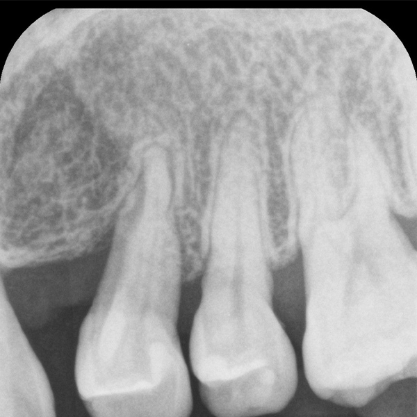 千葉市若葉区の歯周組織再生療法