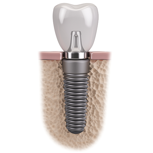 千葉市若葉区のインプラント治療