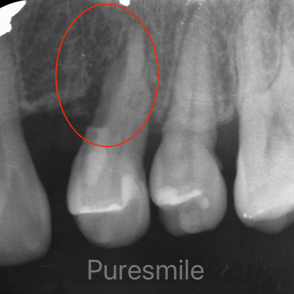 千葉市若葉区の歯周組織再生療法